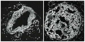 cells of a breast duct exhibiting hyperplasia (left) and one exhibiting carcinoma in situ (right)